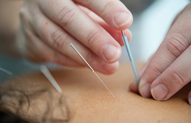 acupuncture or dry needling