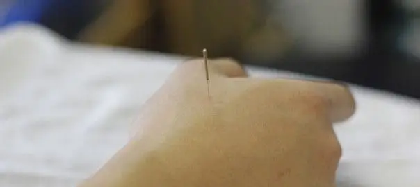 Intramuscular Stimulation Technique Oakville Burlington