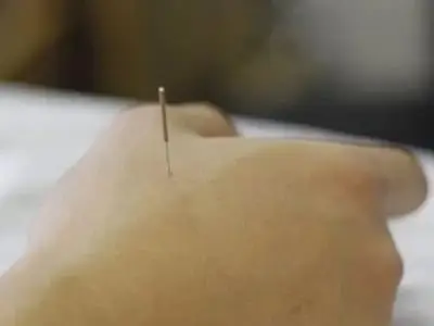 Intramuscular Stimulation Technique Oakville Burlington