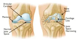 Understanding Knee Arthritis Causes and Symptoms Physiotherapy Oakville