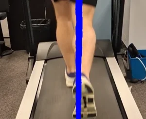 Oakville crossover gait — feet crossing midline on treadmill