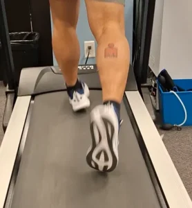 Oakville supination — feet on treadmill